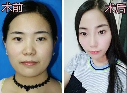 假体隆鼻多少钱