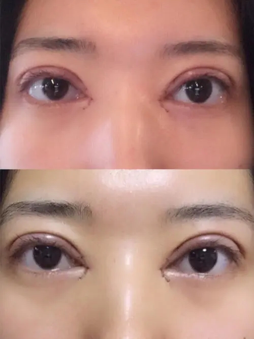 开眼角双眼皮多少钱
