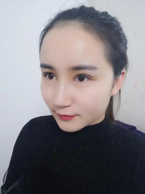 玻尿酸注射鼻子