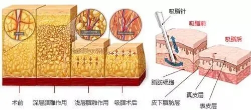 超声波吸脂减肥