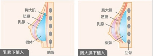 隆胸多少钱-自体脂肪隆胸多少钱