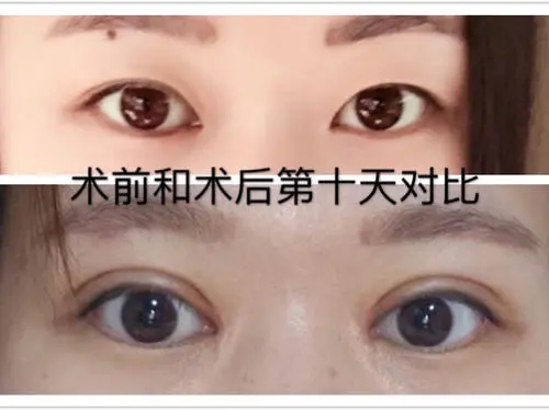 埋双眼皮多少钱