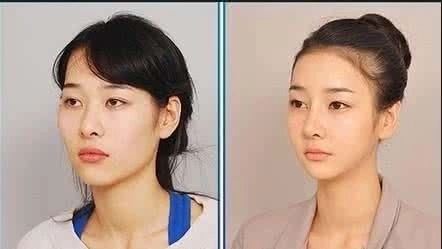 磨骨瘦脸术要多少钱