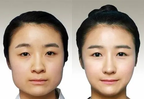磨骨一般多少钱
