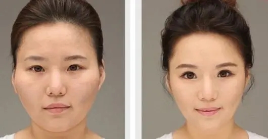 瘦脸整形多少钱