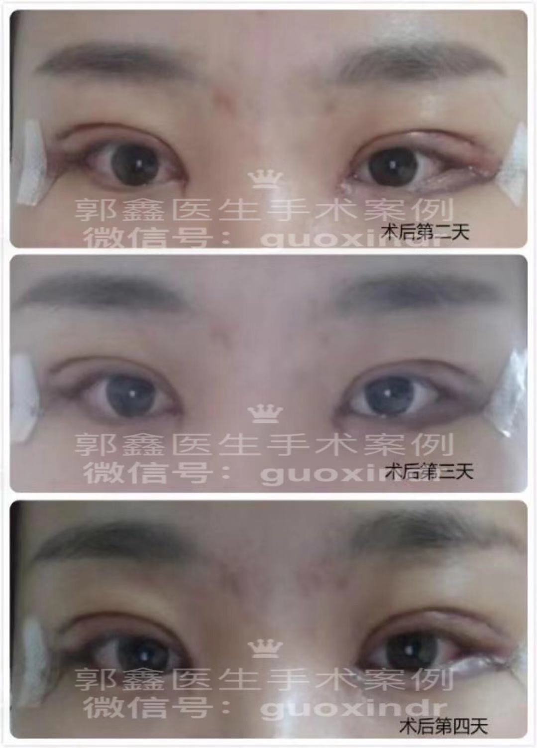 做双眼皮哪里好