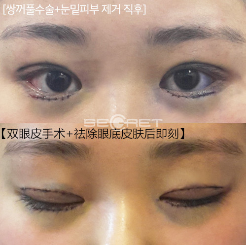 做双眼皮哪里好